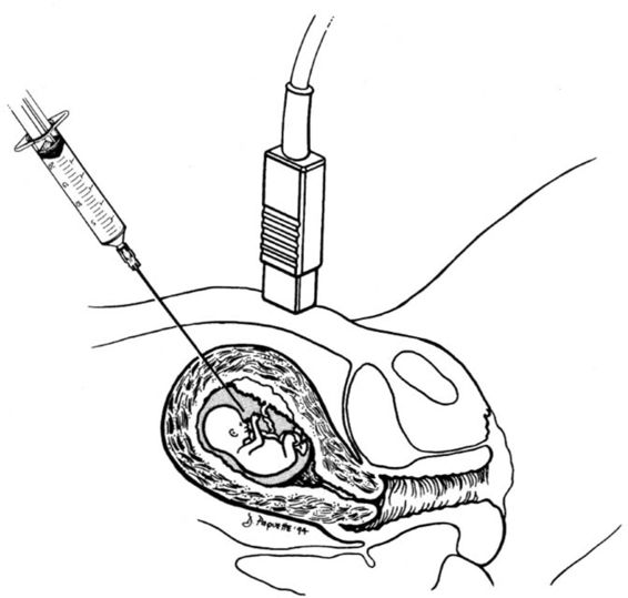Invasive Prenatal Diagnostic Procedures Obgyn Key