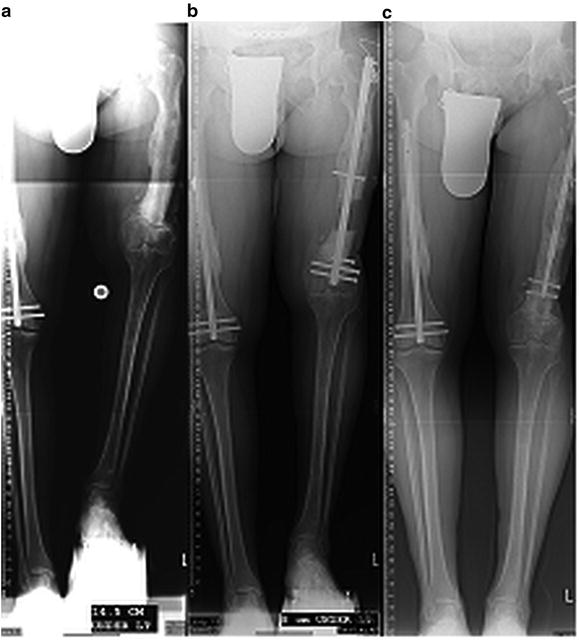 Motorized Intramedullary Lengthening, an Emerging Technology for Limb Length and Deformity