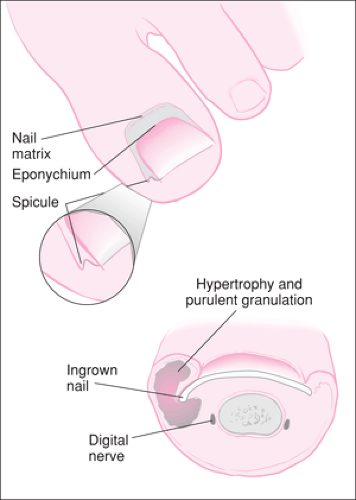 Ingrown Toenail Repair | Obgyn Key