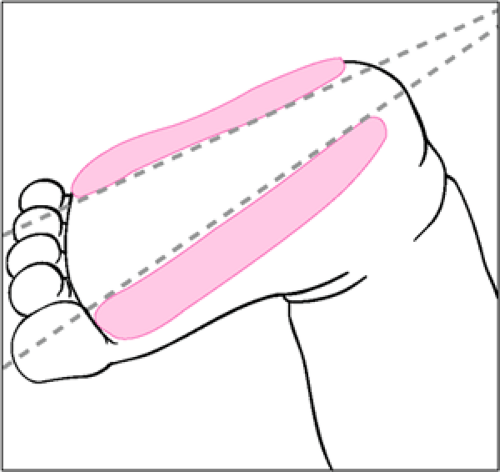 Heel Sticks | Obgyn Key