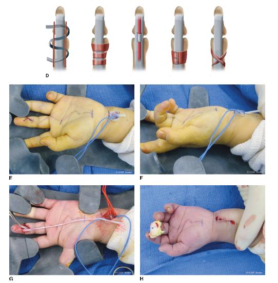 Traumatic Tendon Injuries Obgyn Key