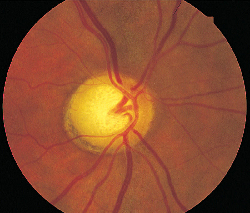 Ophthalmology Obgyn Key