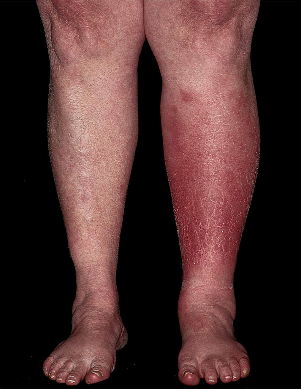 Dermatologic Diseases Obgyn Key