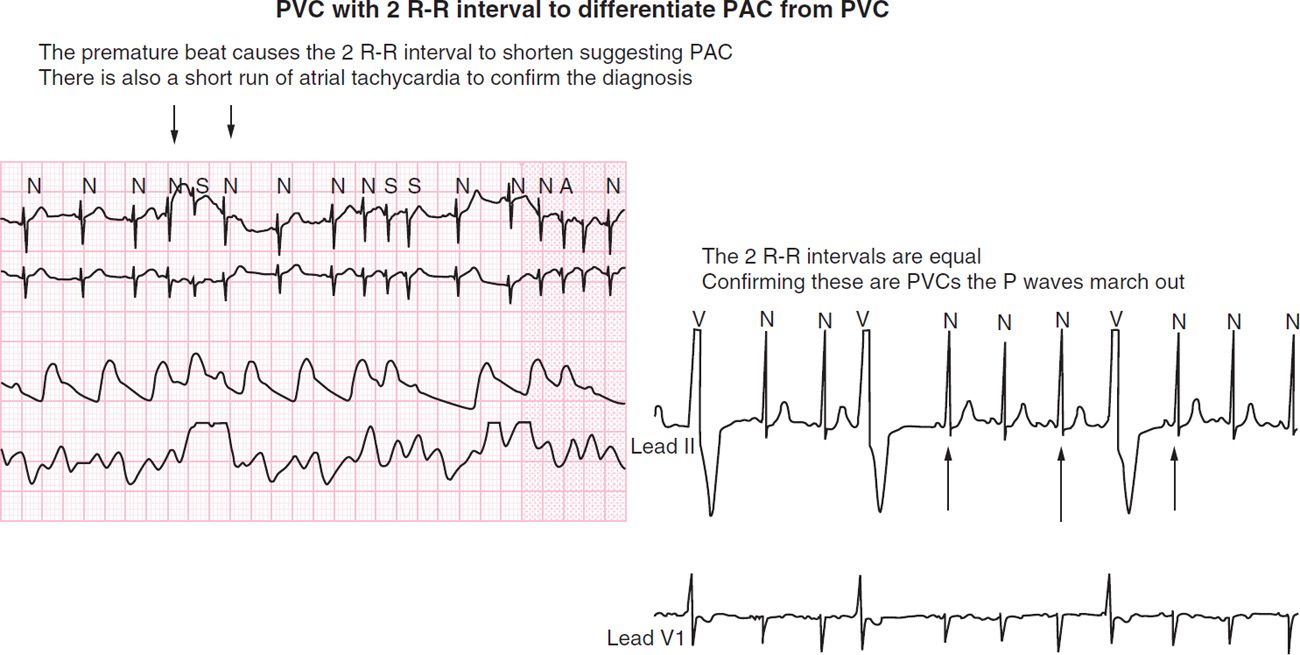 Neonatal Arrhythmias Obgyn Key