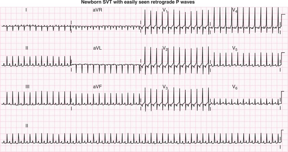 Neonatal Arrhythmias Obgyn Key