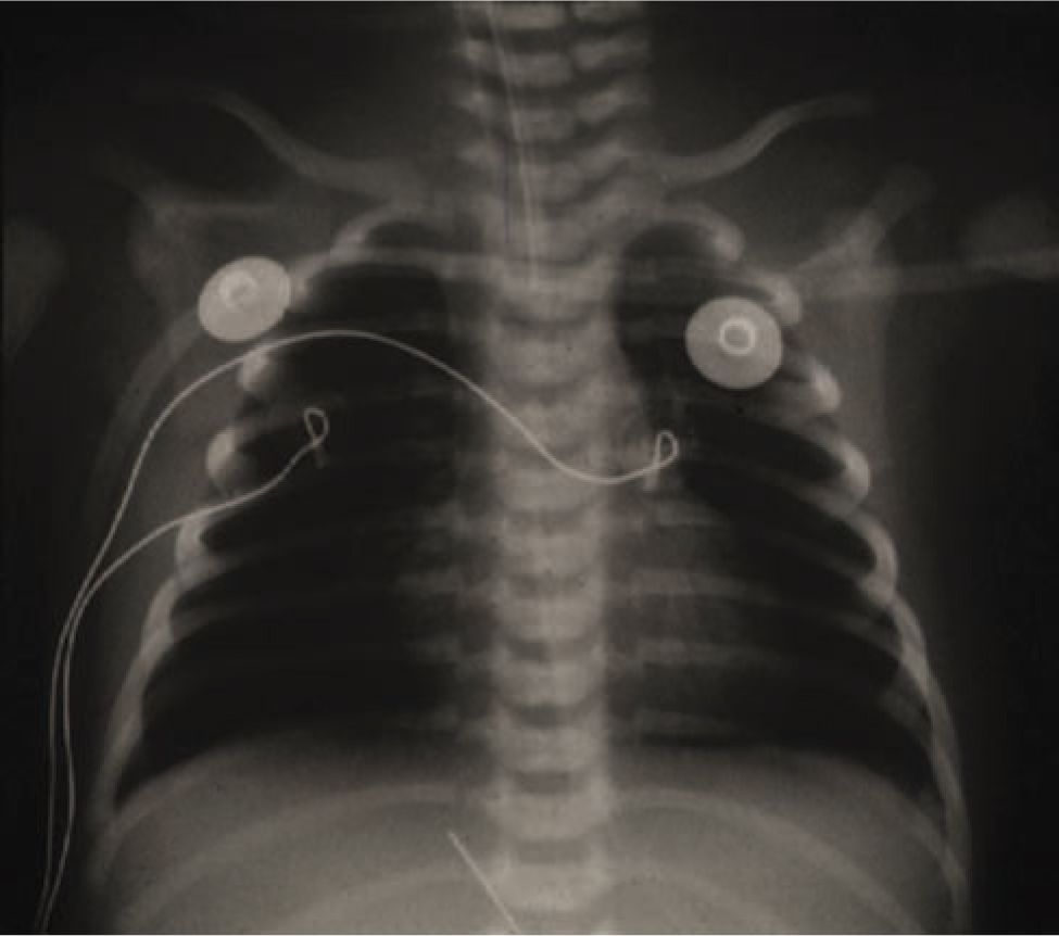 Refractory Hypoxemic Respiratory Failure Obgyn Key