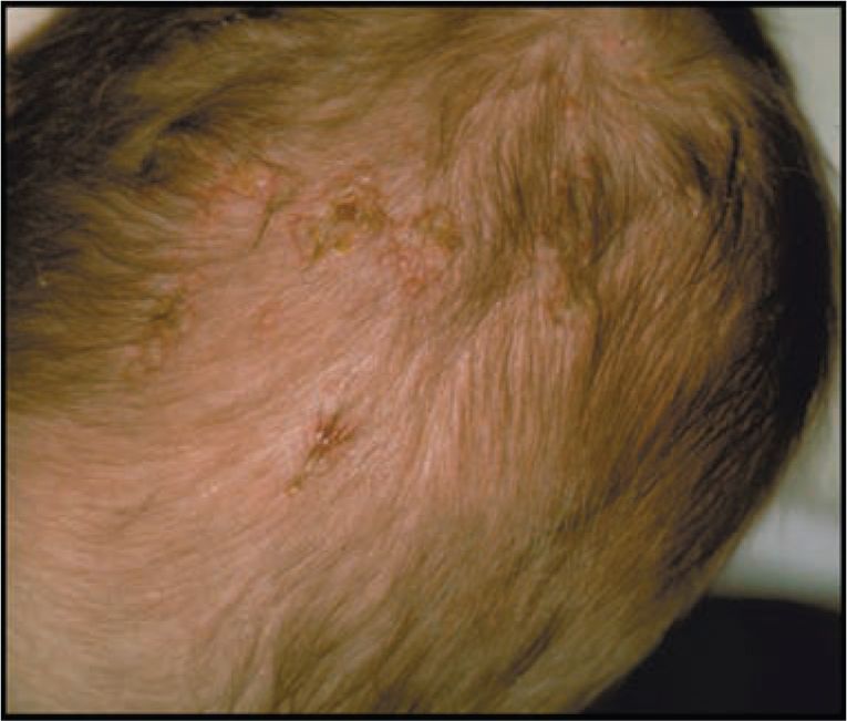 Herpes Simplex Virus Obgyn Key