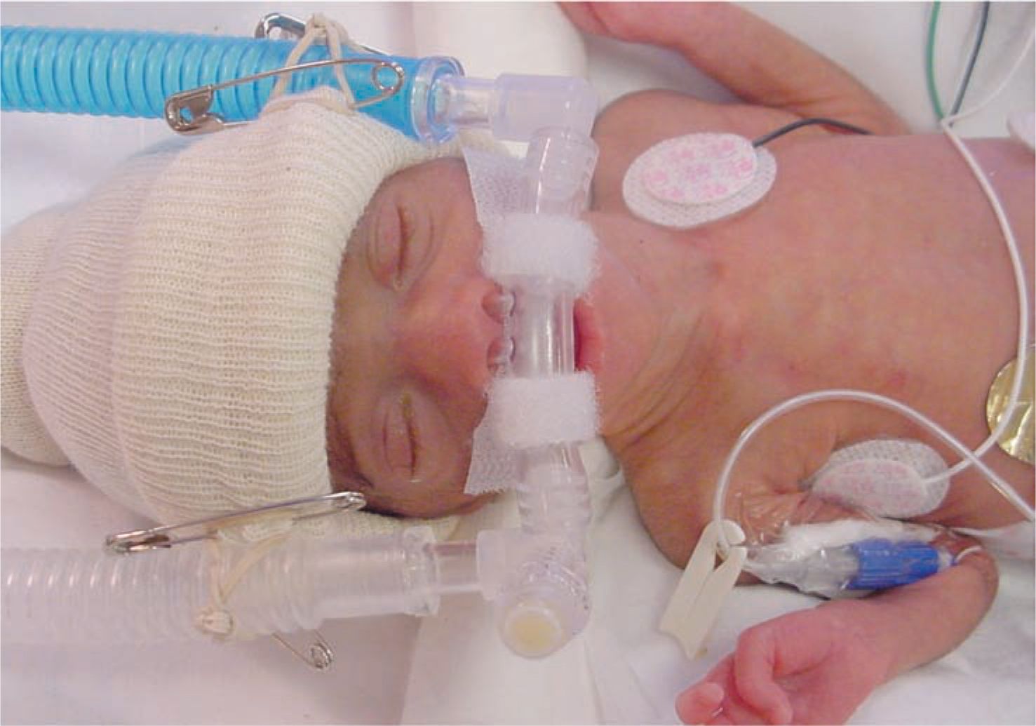 Noninvasive Support of Respiratory Failure Obgyn Key