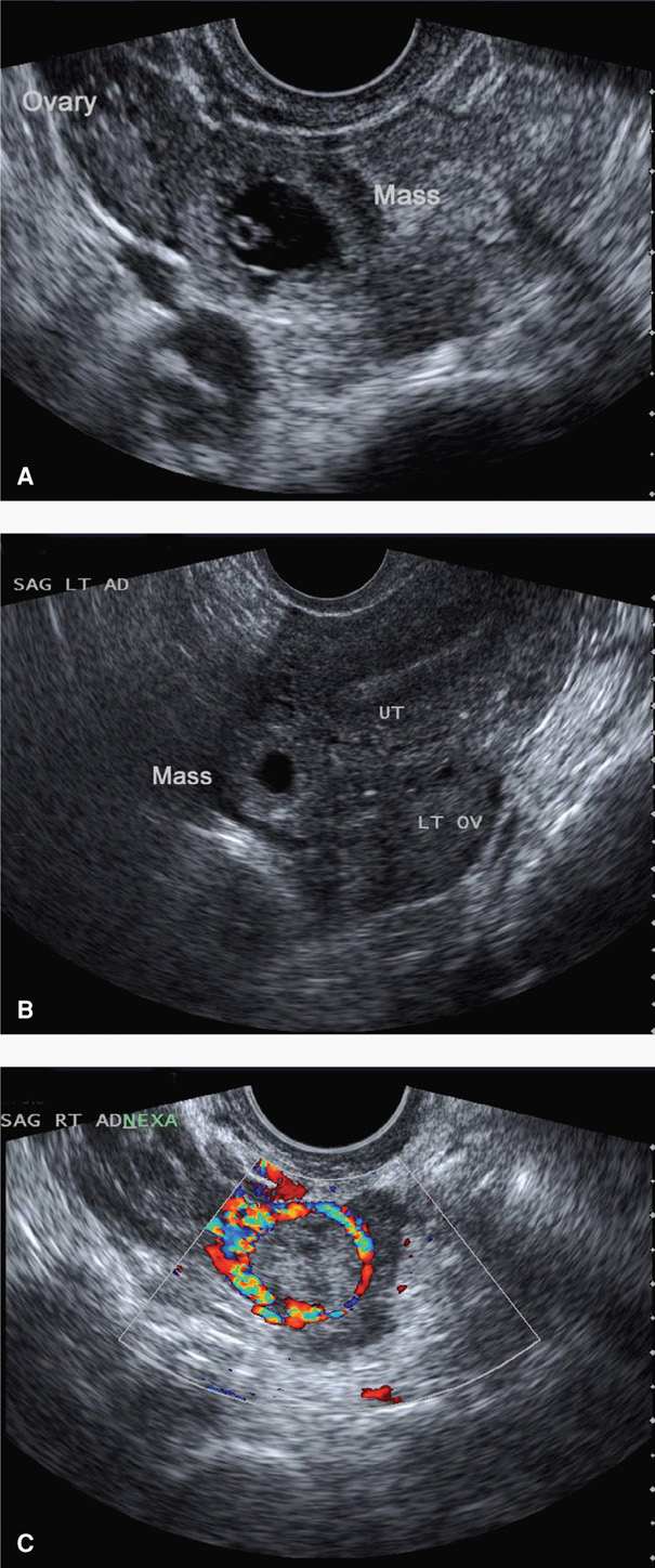 Ectopic Pregnancy Obgyn Key