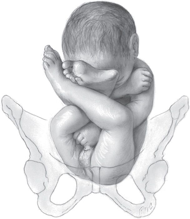 Breech Delivery Obgyn Key