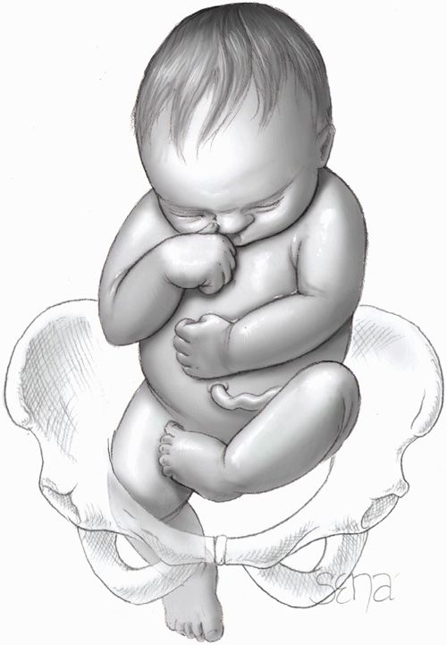 Breech Delivery Obgyn Key