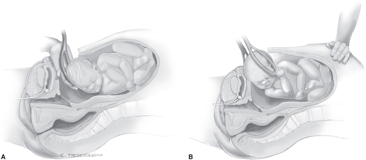 Cesarean Delivery and Peripartum Hysterectomy Obgyn Key
