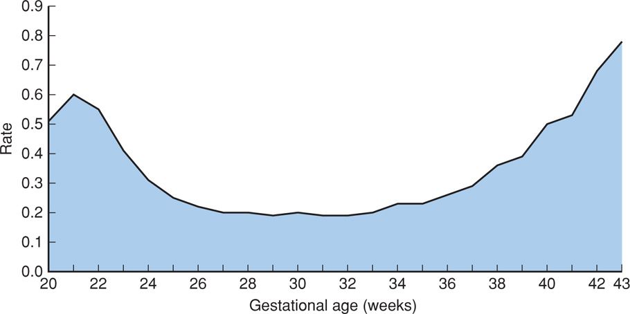 Stillbirth Obgyn Key