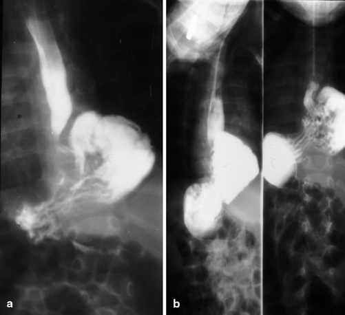 Congenital Paraesophageal Hernia Obgyn Key