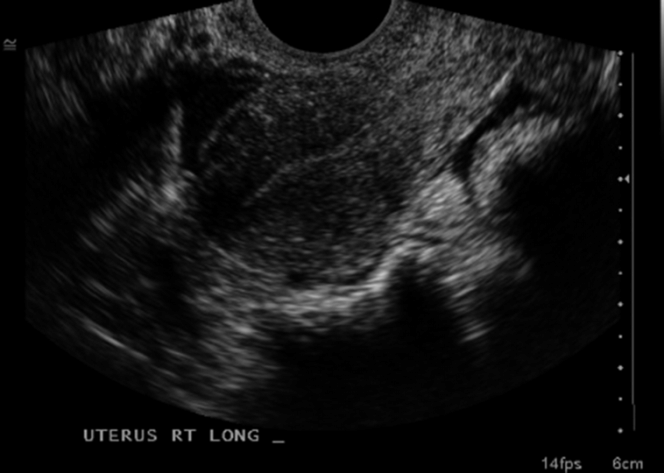 Abnormal first trimester pregnancy Obgyn Key