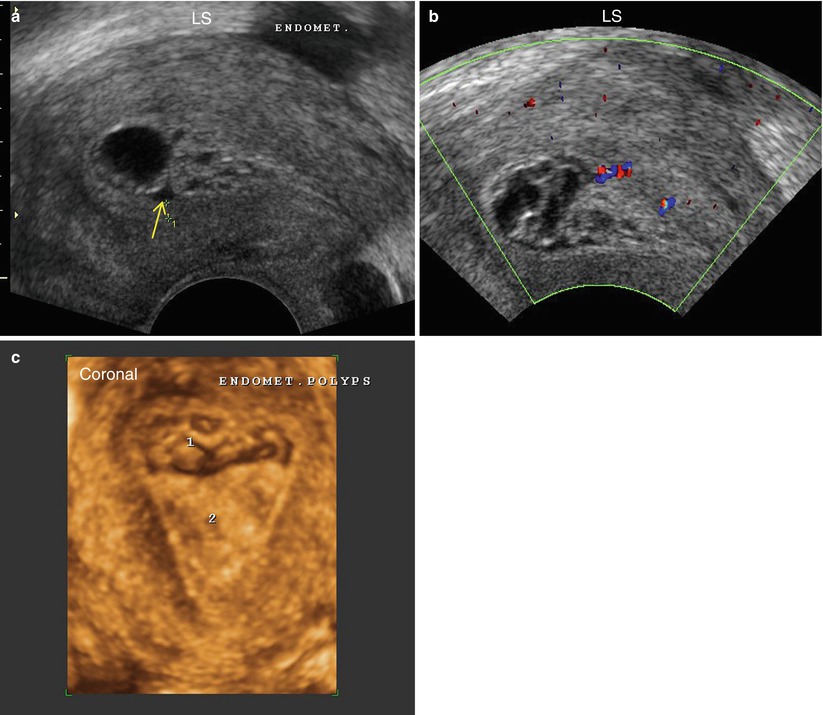 Ultrasound Evaluation of Endometrium Obgyn Key