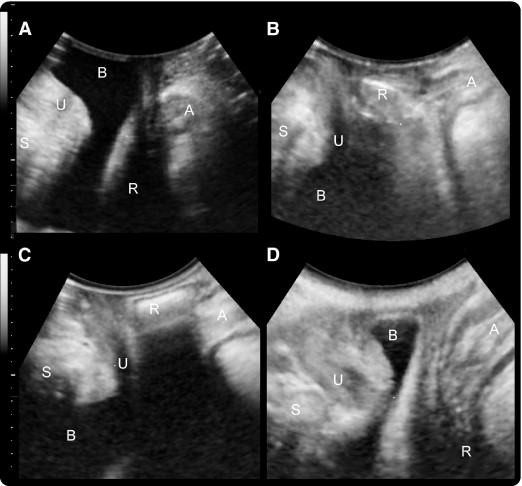 Pelvic floor ultrasound a review Obgyn Key