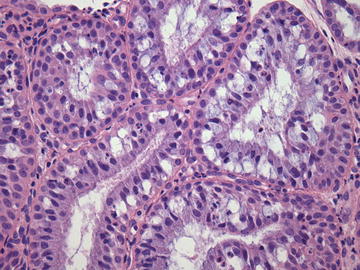 cytologic-mimics-of-endocervical-glandular-neoplasia-obgyn-key