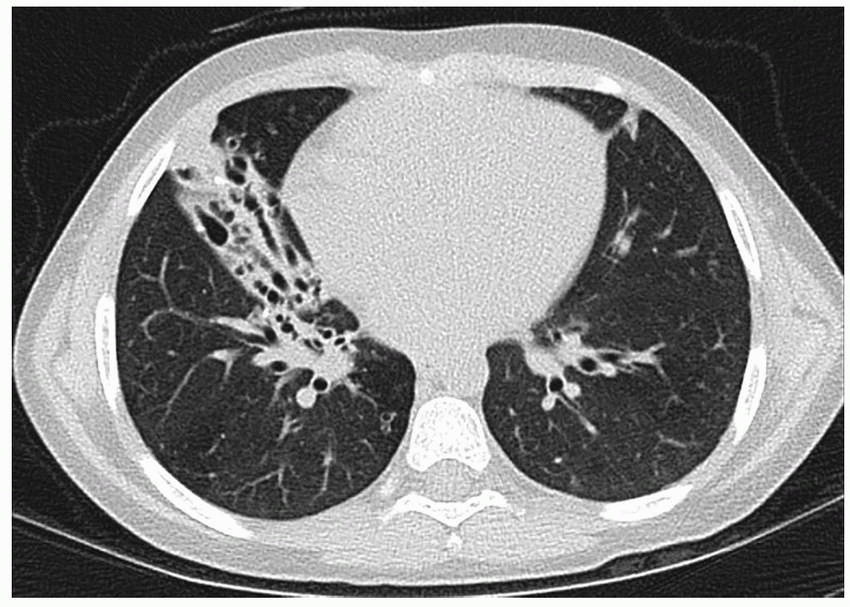 Pediatric Chest Radiology Obgyn Key