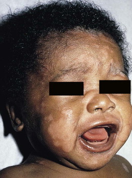 Hypopigmentation Disorders Obgyn Key