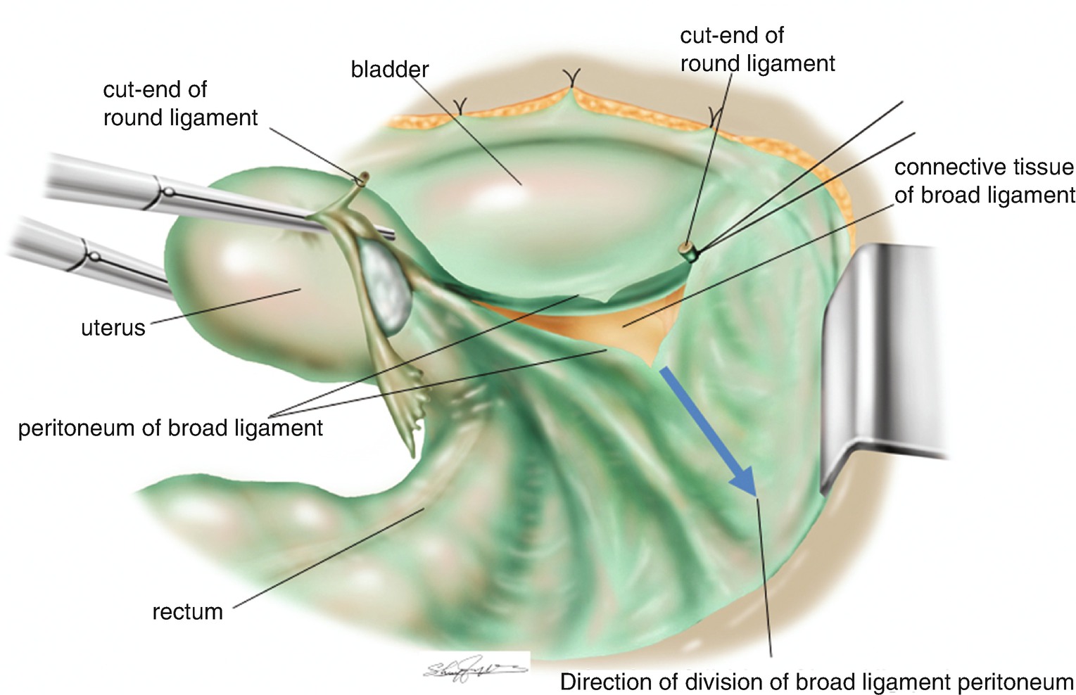 Radical Hysterectomy with Pelvic Lymphadenectomy (Without NerveSparing