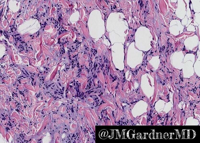 Spindle Cell Lipoma 101 KiKo XP