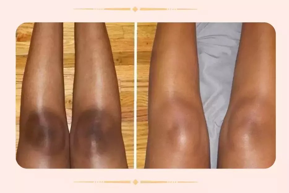 How To Lighten Dark Knees DIY At Home Guide obxess