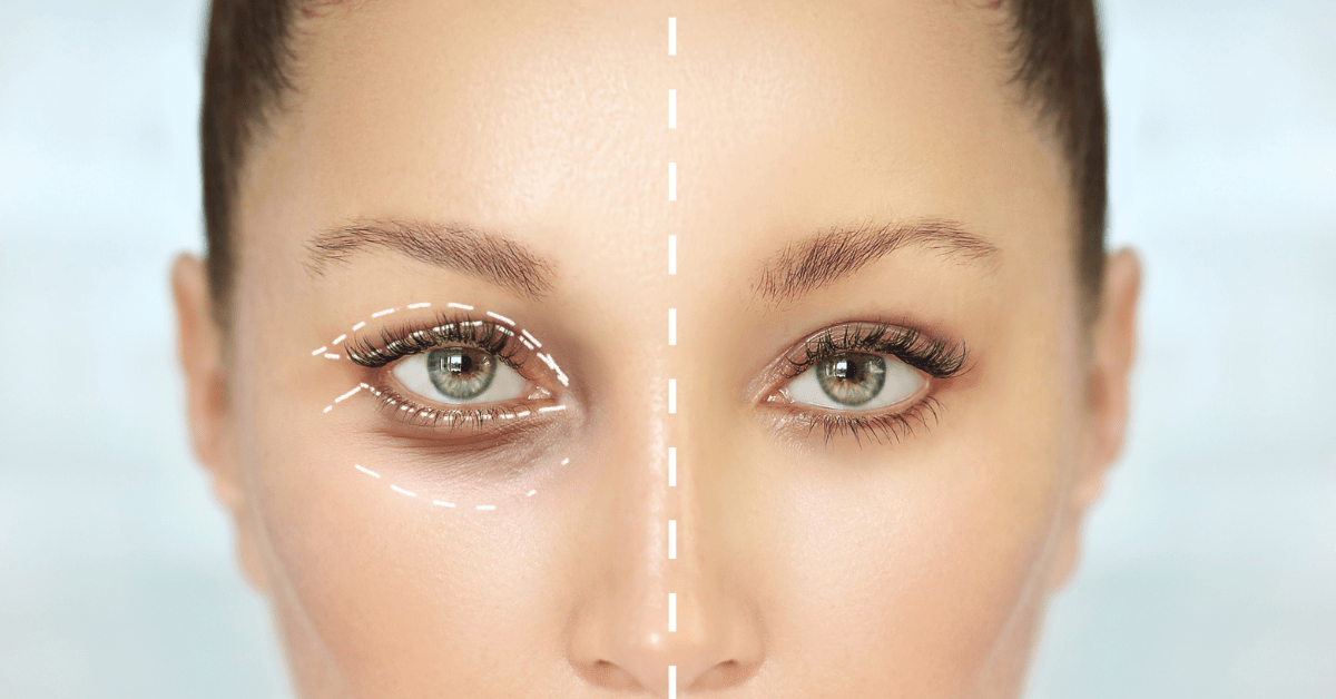 How Much Does an Eyelid Surgery Cost? OcalaEye Eyelids