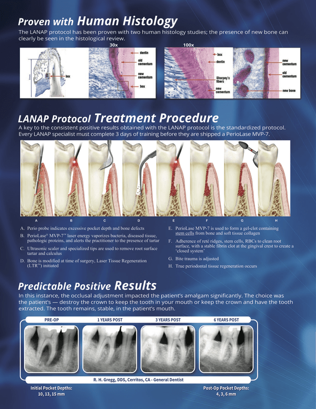 LANAP™ Laser Ocala Periodontics & Dental Implants