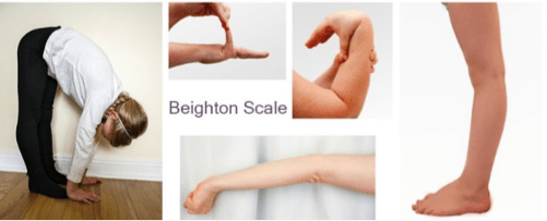 Hypermobility in Children Occupational Therapy Helping