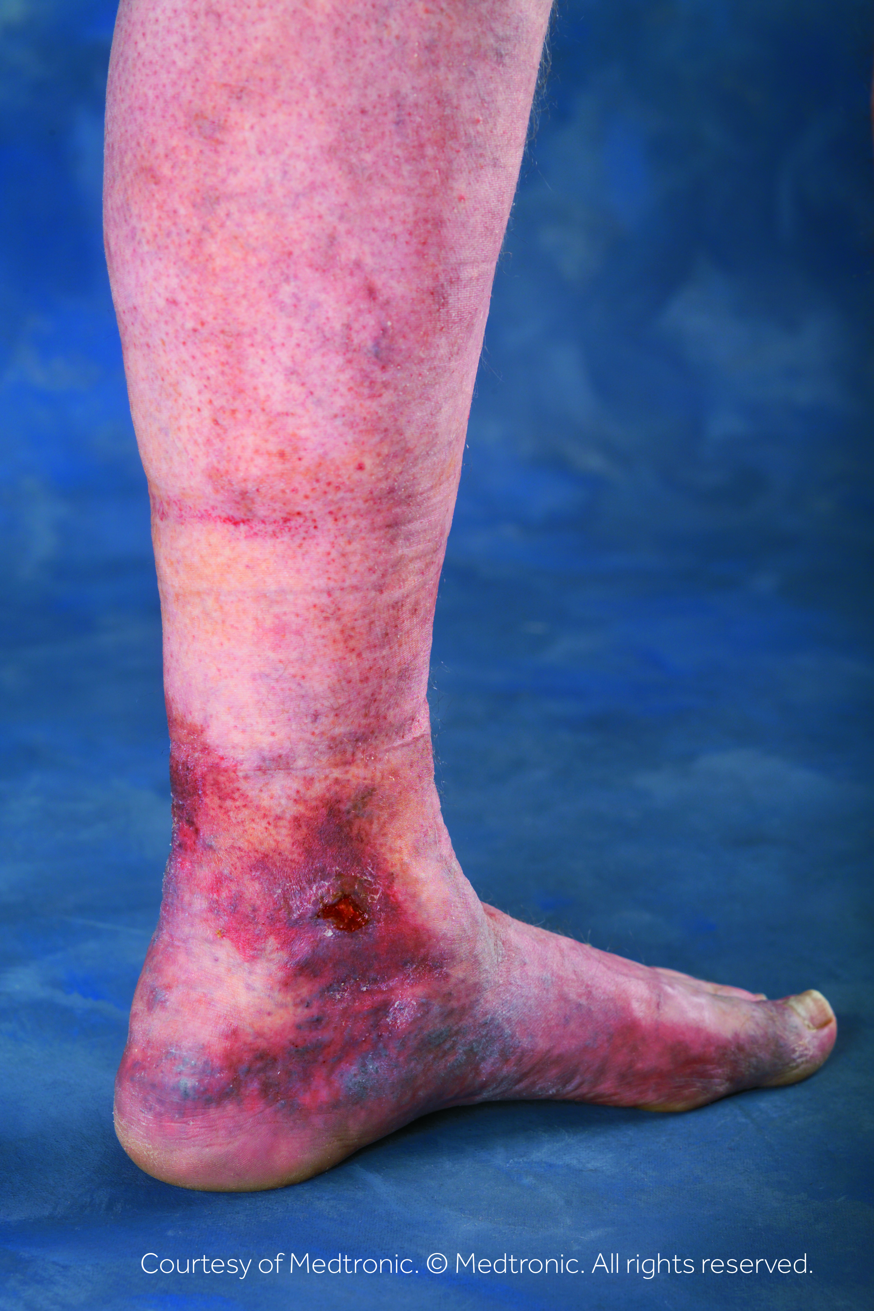 LowerLegUlcerImage Oceana Vein Specialists