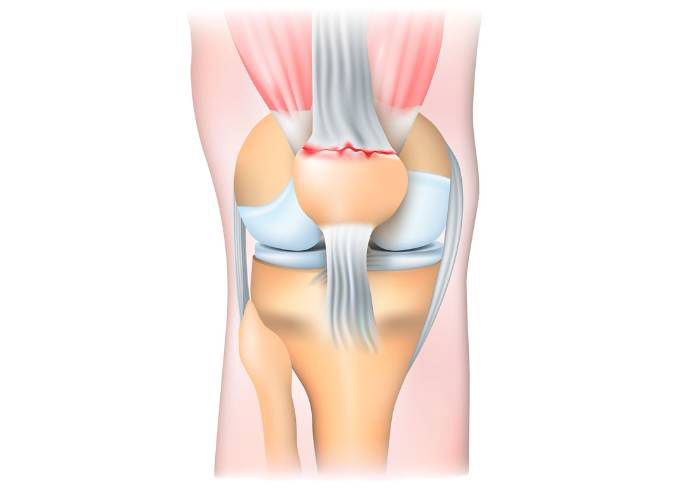 Quadriceps Tendon Tear Rupture Specialist Los Angeles, Orange County, CA