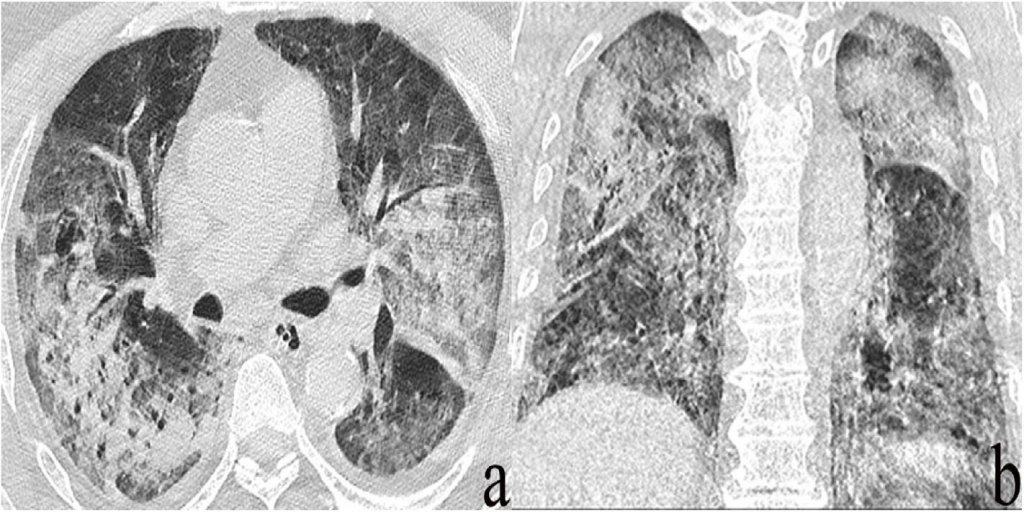 FAQ HRCT in COVID19 Orange City Hospital & Research Institute