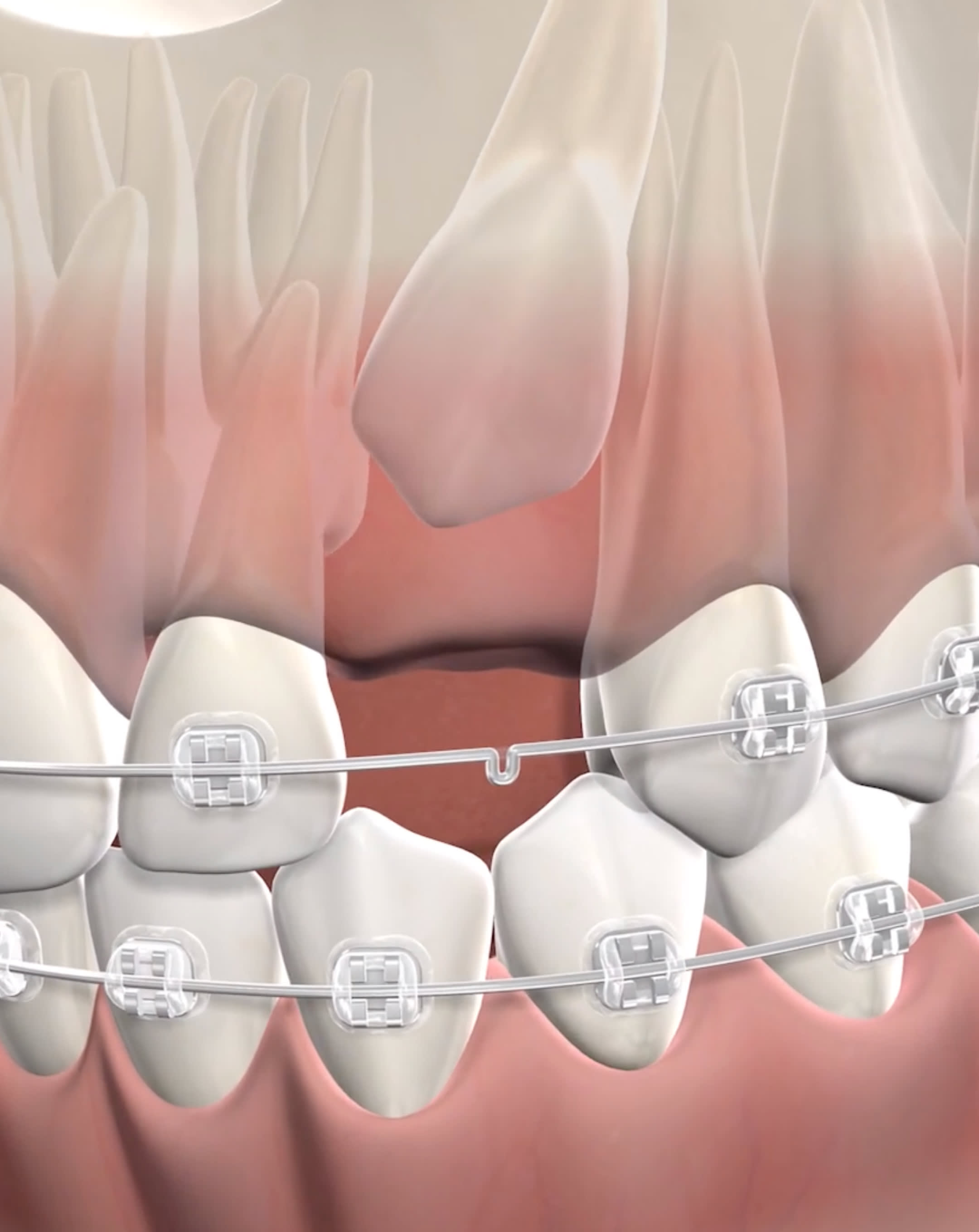 Impacted Canines in Aliso Viejo, CA OC Oral Surgery