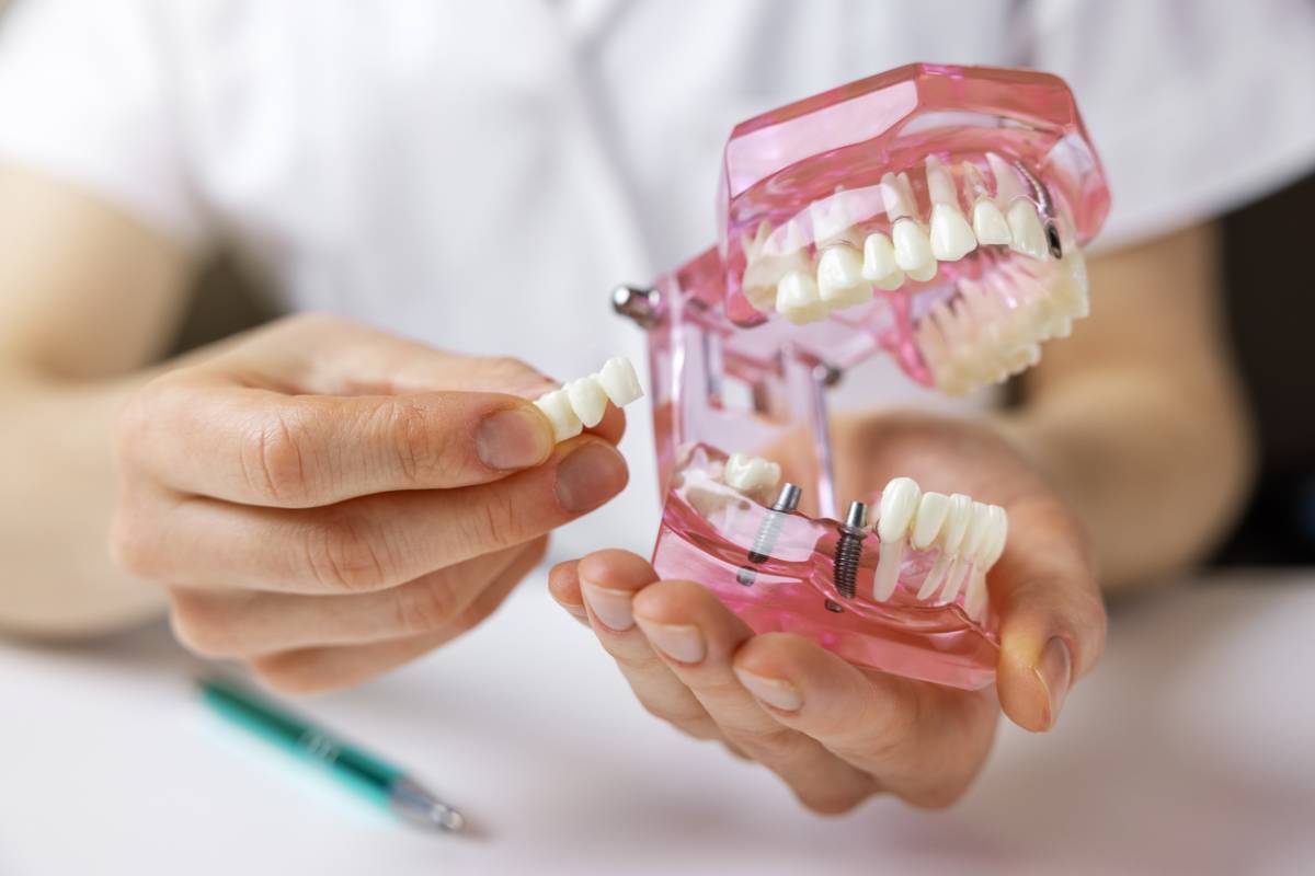 Do dental implants fall out? Irvine Restorative Dentistry Blog