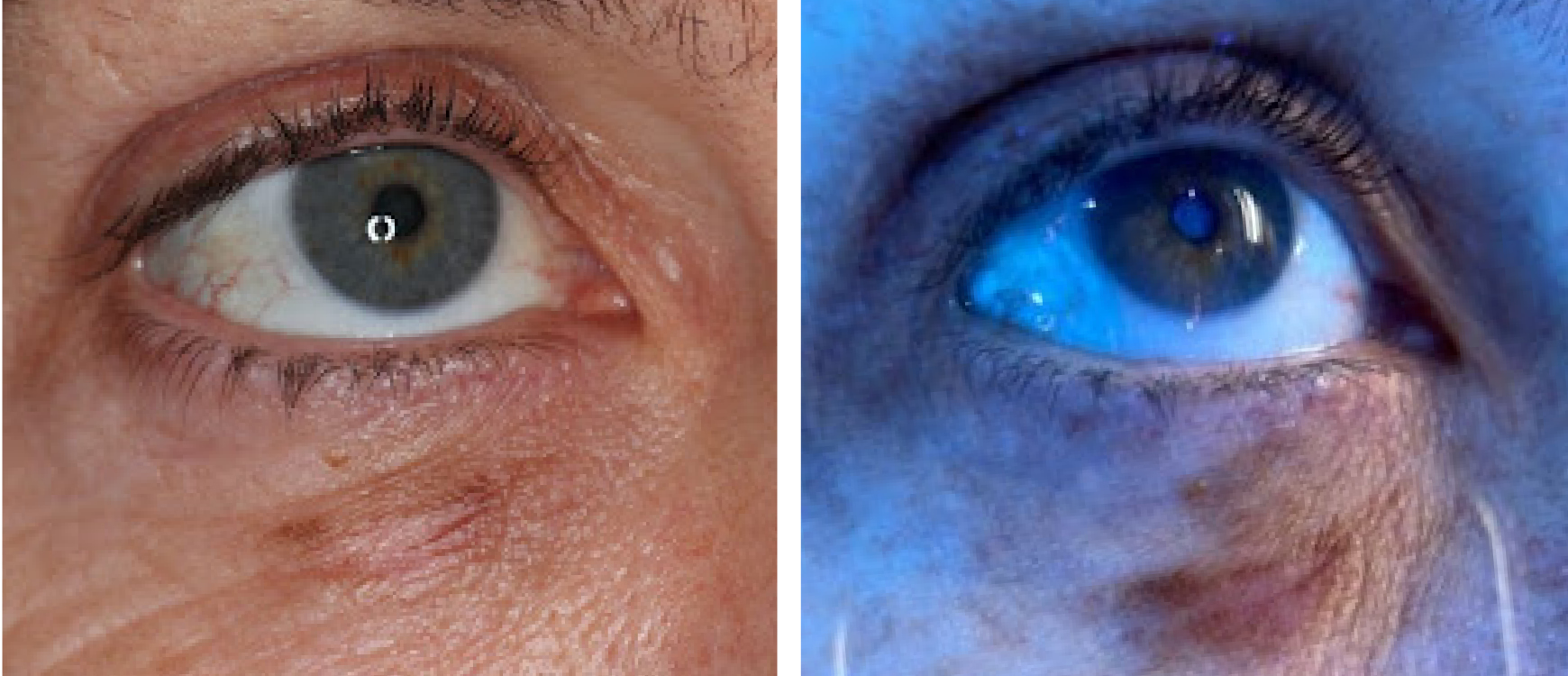 Evaluating Lesions with Blue Light Skin Cancer And Reconstructive