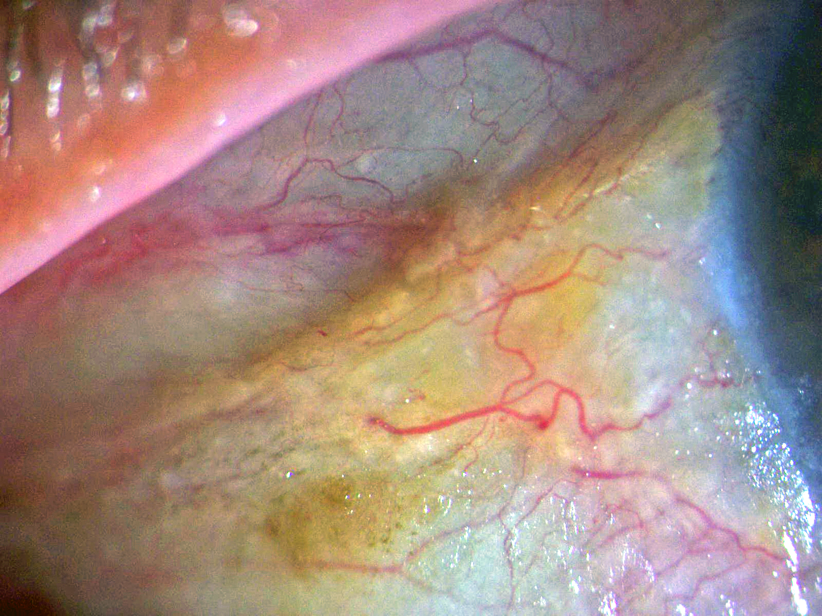 Bitot's spots in vitamin A deficiency