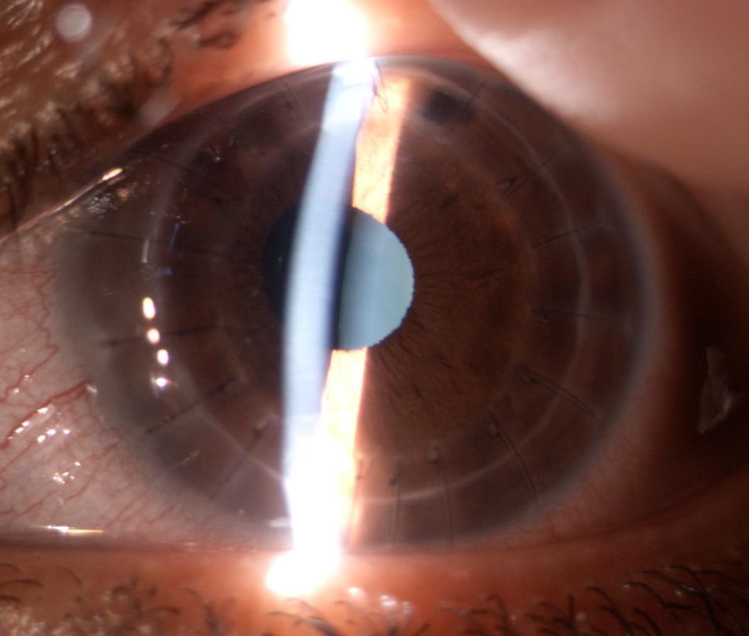 Contact Lens Associated Keratitis