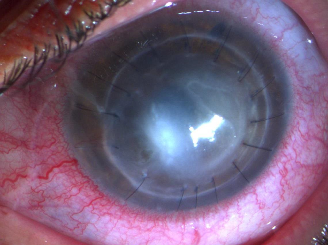 Contact Lens Associated Keratitis
