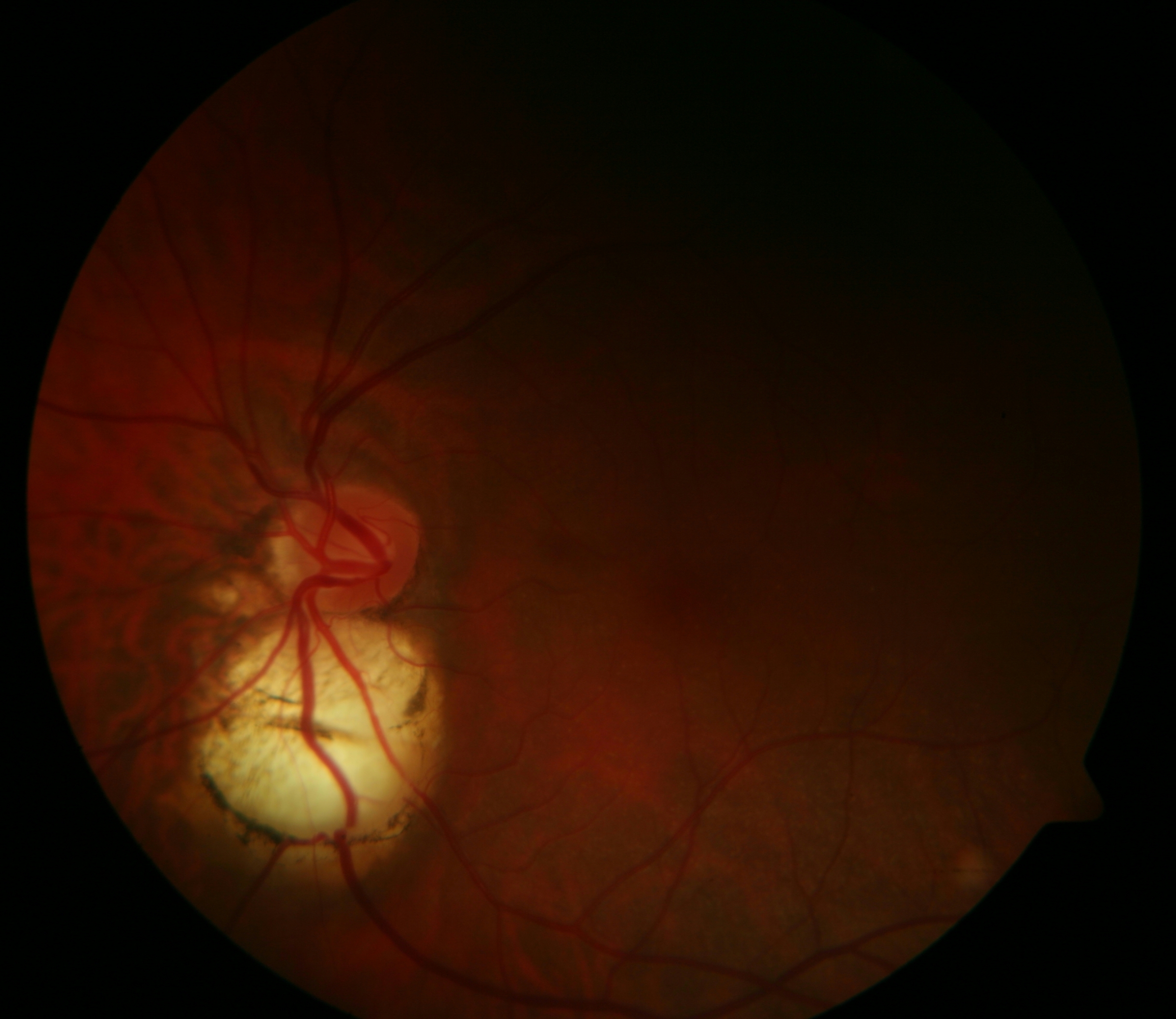 Iris Coloboma
