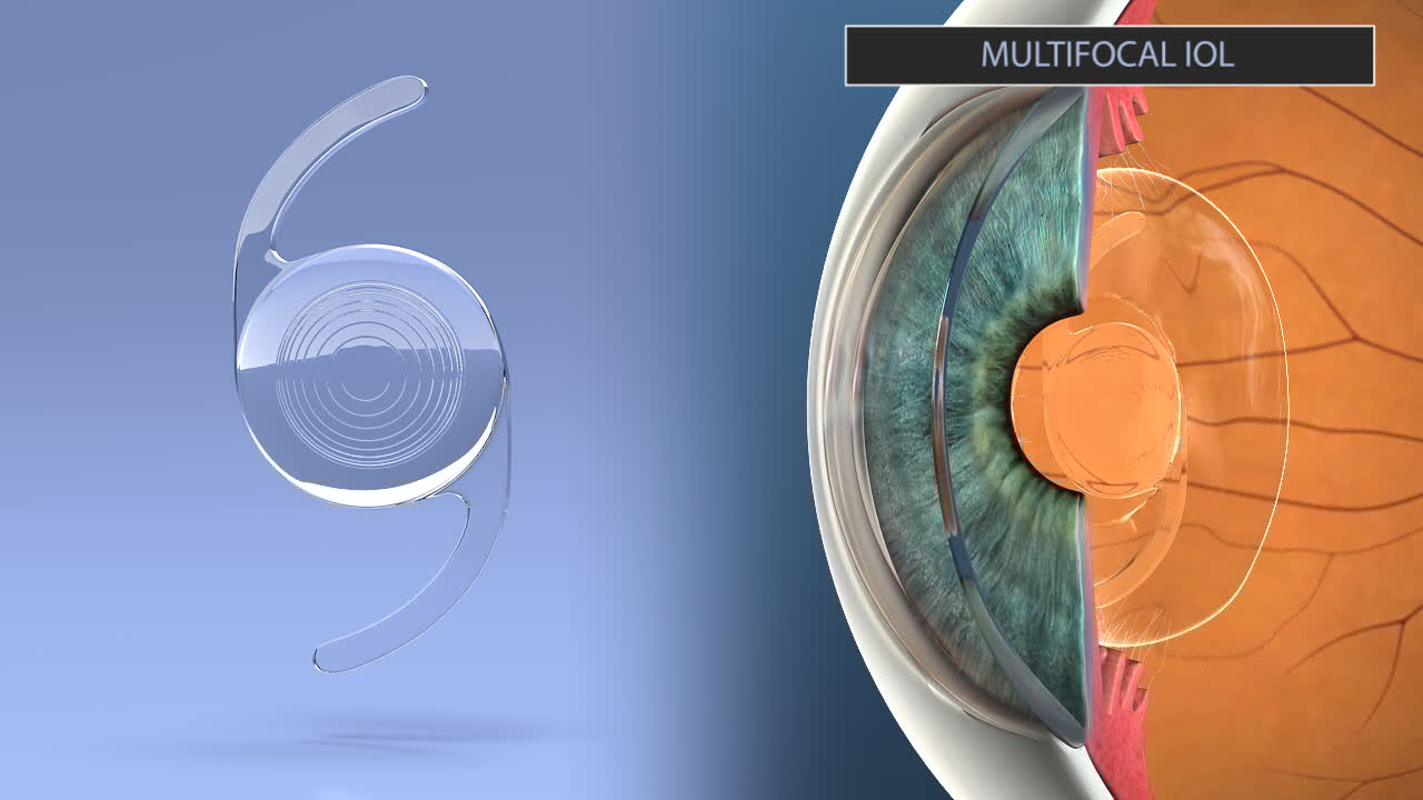 Selecting an Intraocular Lens (IOL) Ophthalmic Consultants of Vermont