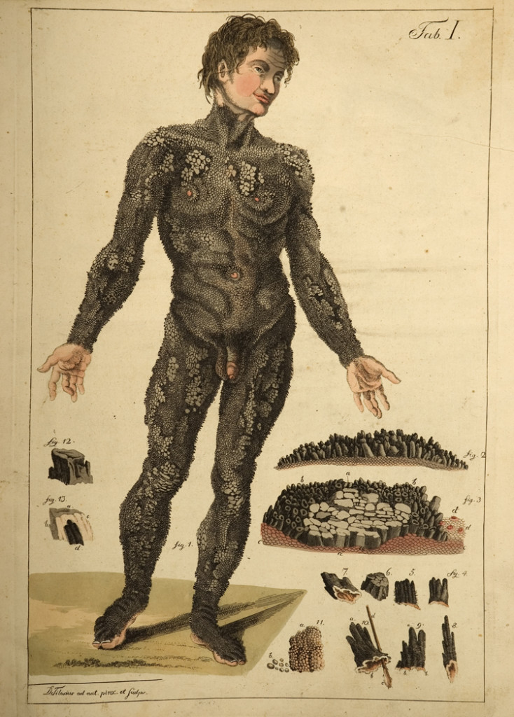 10 Weird Skin Diseases You Need To See To Believe