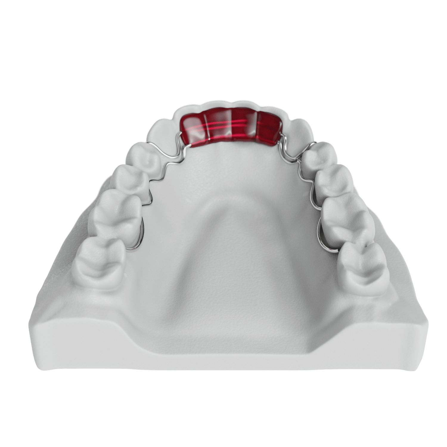 Spring Aligner Appliance with Lingual Extensions ODL Orthodontic Labs