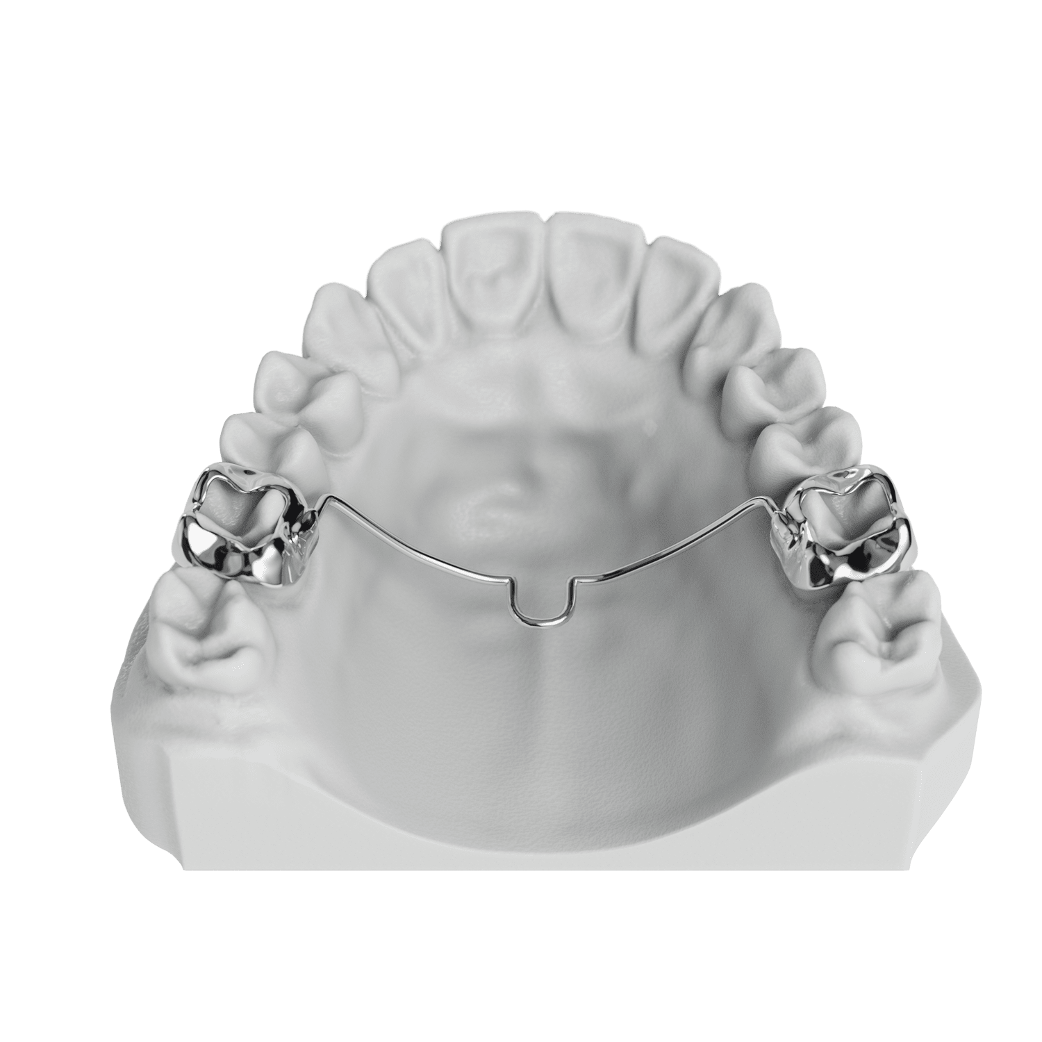 TPA (Transpalatal Arch) ODL Orthodontic Labs