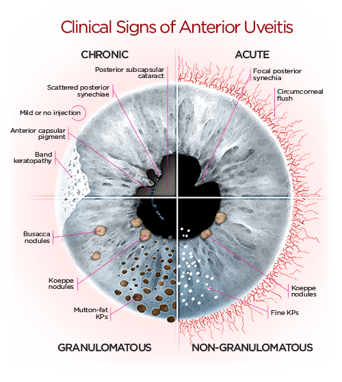 How I Manage Anterior Uveitis Pacific Cataract and Laser Institute