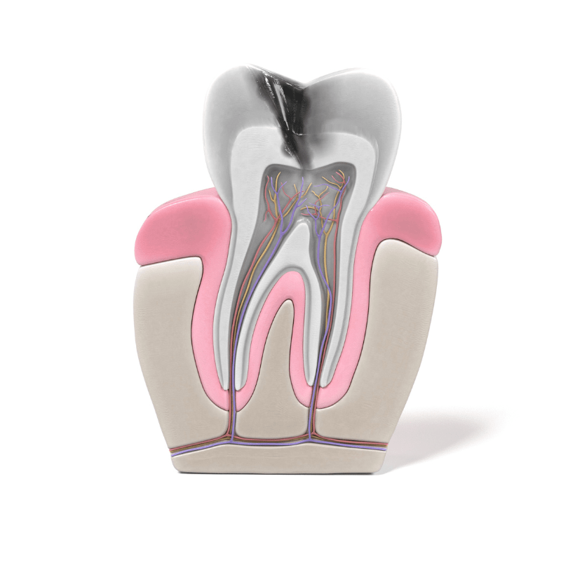 Root Canals ODS Dental Surgery