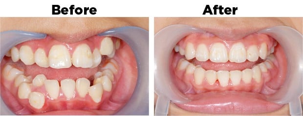 When you know that you need braces