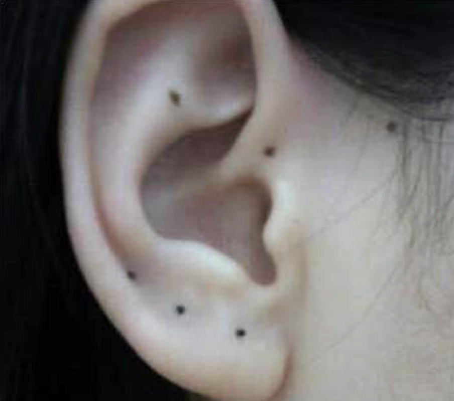 Tatto Removal Using Picosecond Laser Salt Lake City, Utah