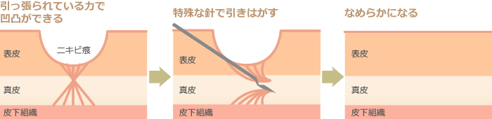 【医師監修】大人ニキビやニキビ跡の治療には保険がきく？ 原因・種類・治療法を解説 Oggi.jp