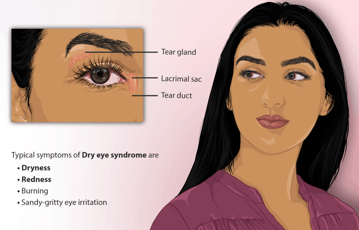 Dry Eyes Best 100 Ayurveda Treatment, Symptoms, Home Remedies